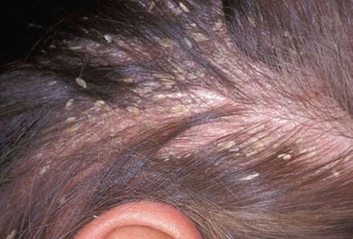 seborrheic dermatitis hair loss seborrheic dermatitis hair loss